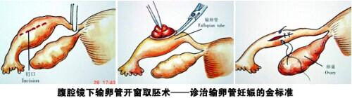 什么是宫外孕?宫外孕的危害及预防!