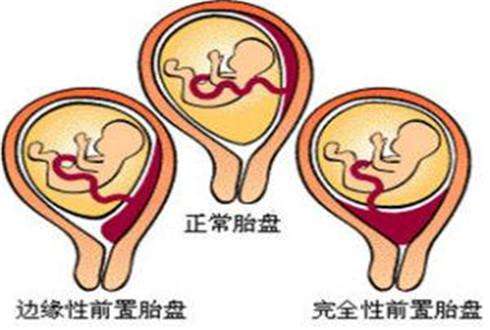 引产的相关知识
