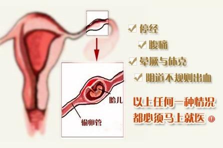 宫外孕一般多久有感觉?早发现早处理