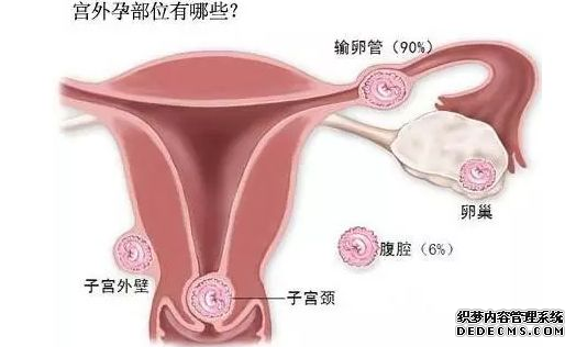 石河子妇科：“坑娘”的宫外孕